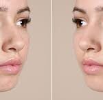 5 Most Effective Way To Clear Acne Fast